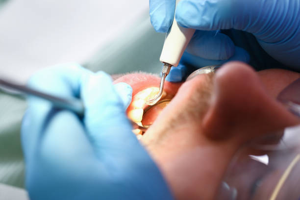 Best Chipped Tooth Repair Near Me  in Mount Sterling, IL